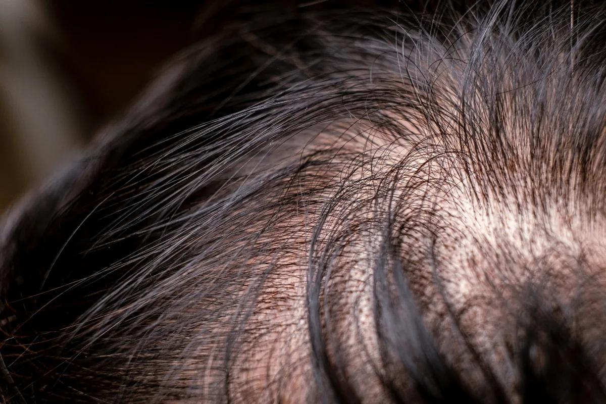 Até que ponto a queda de cabelo é considerada normal?