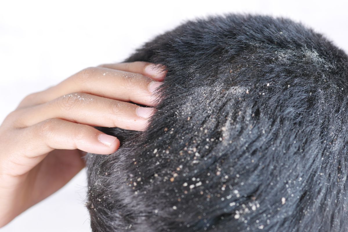 5 maneiras de acabar com a dermatite seborreica