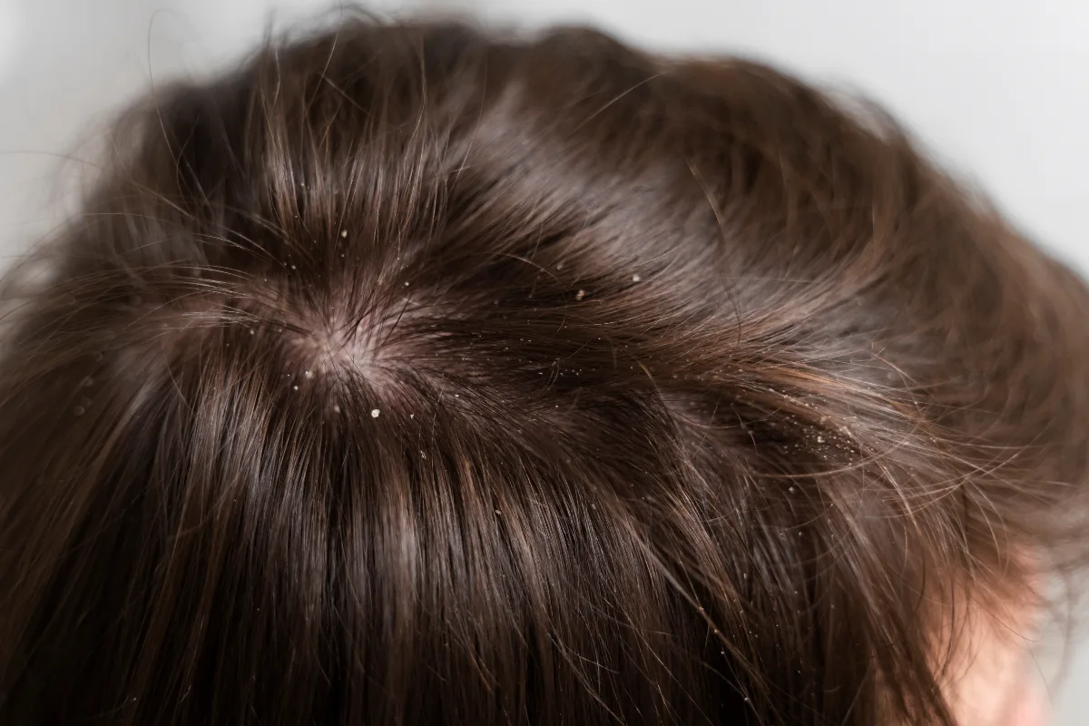 Qual o melhor shampoo para caspa?